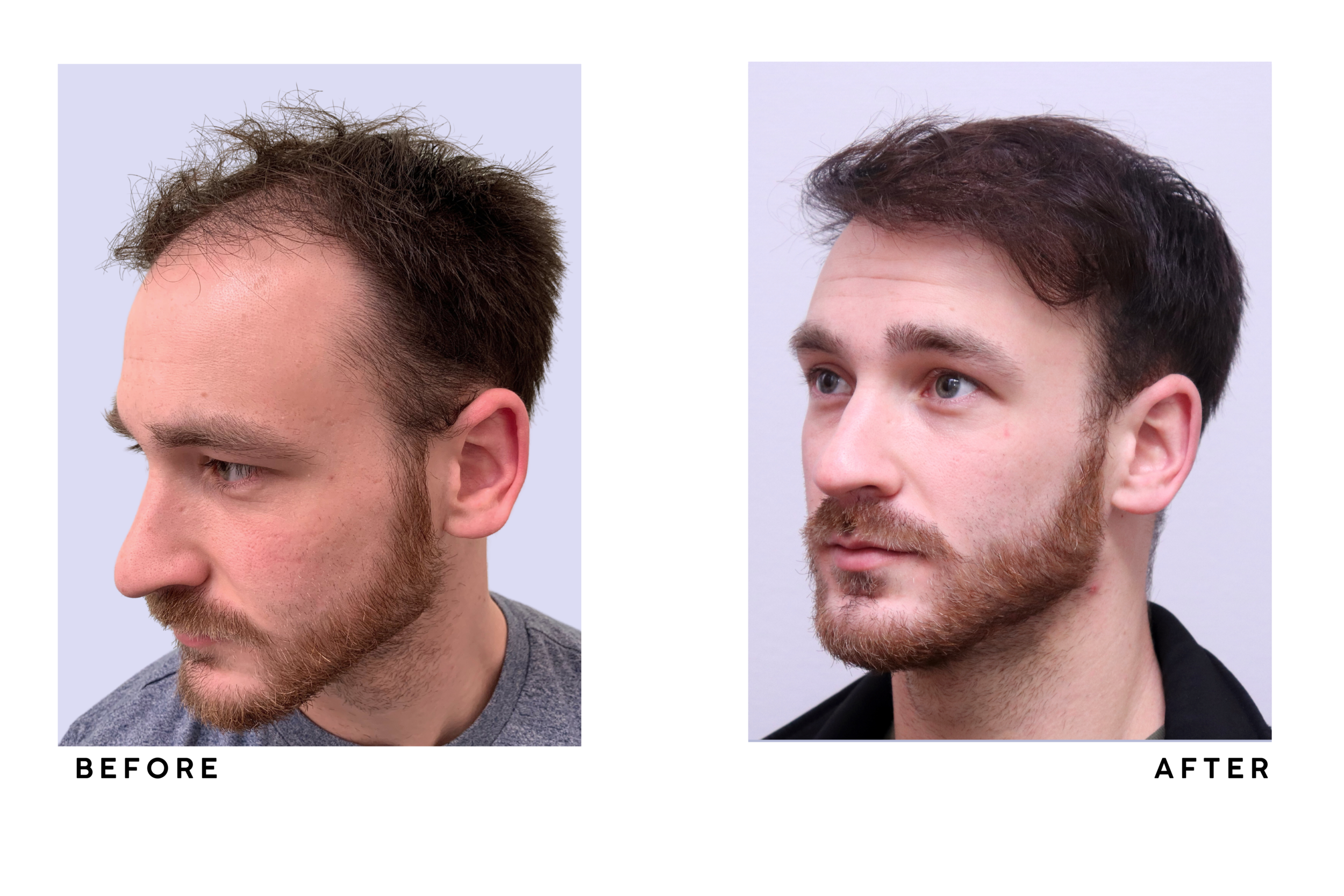 A patient's hair before and after