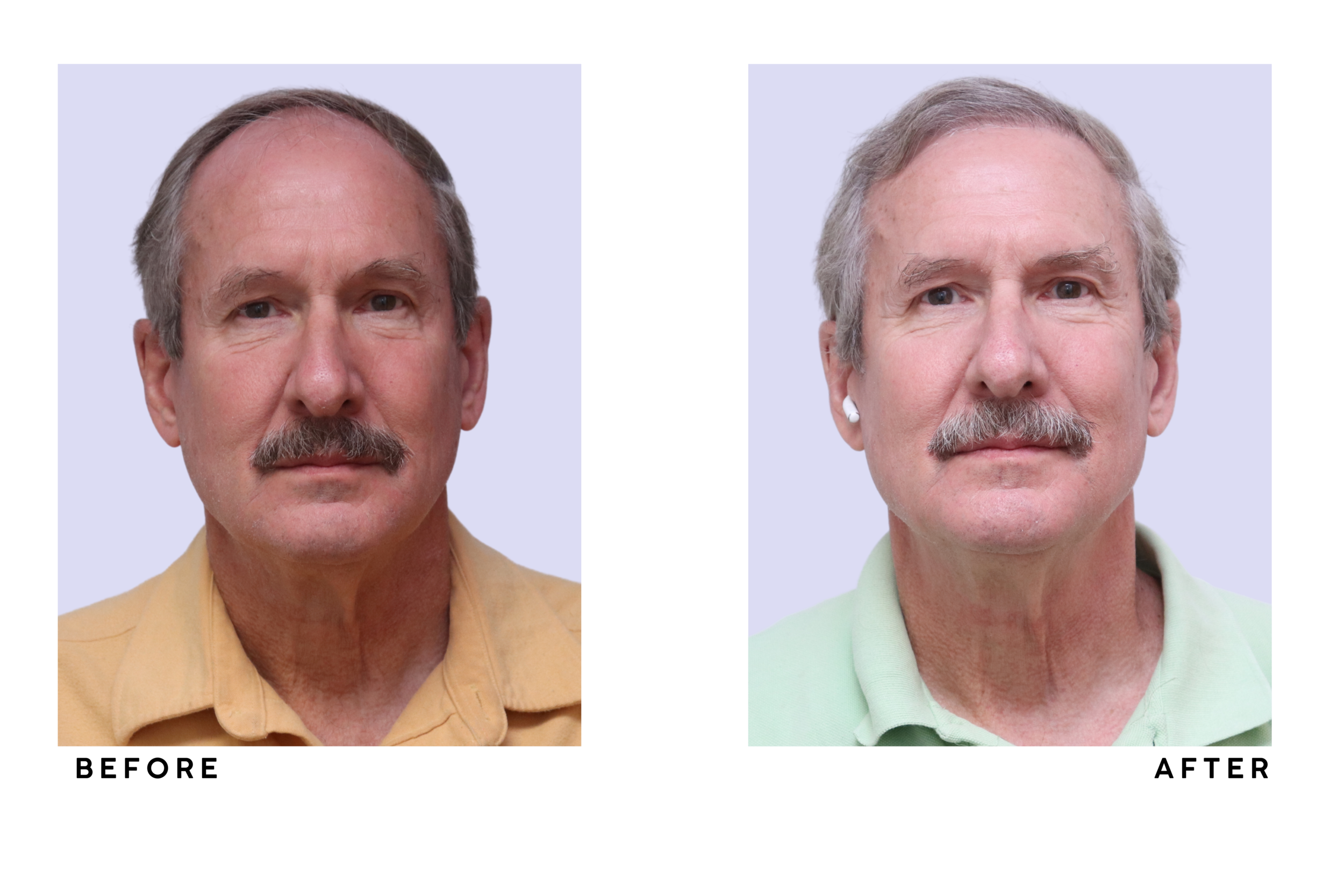 A patient's hair before and after