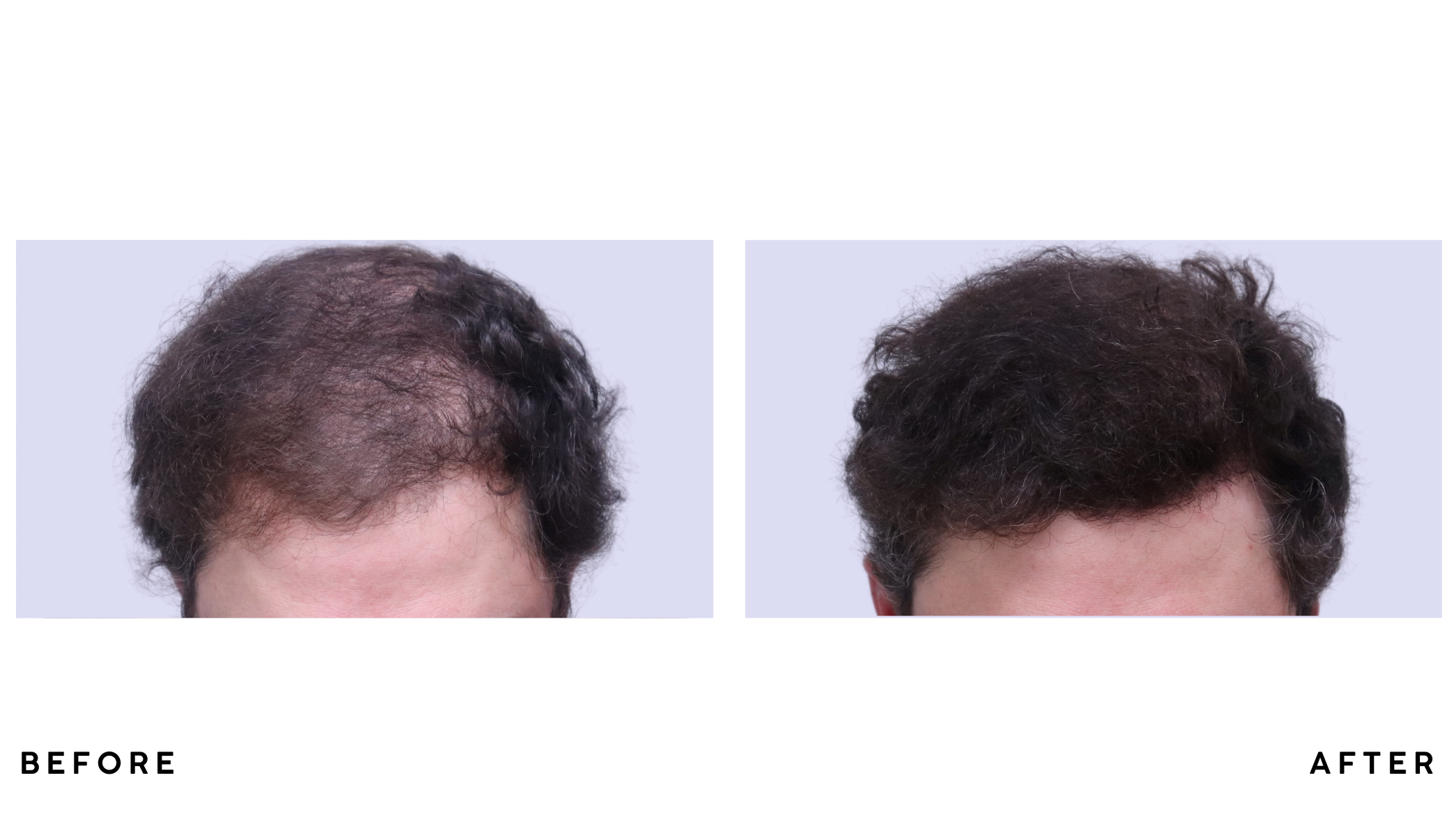 A patient's hair before and after