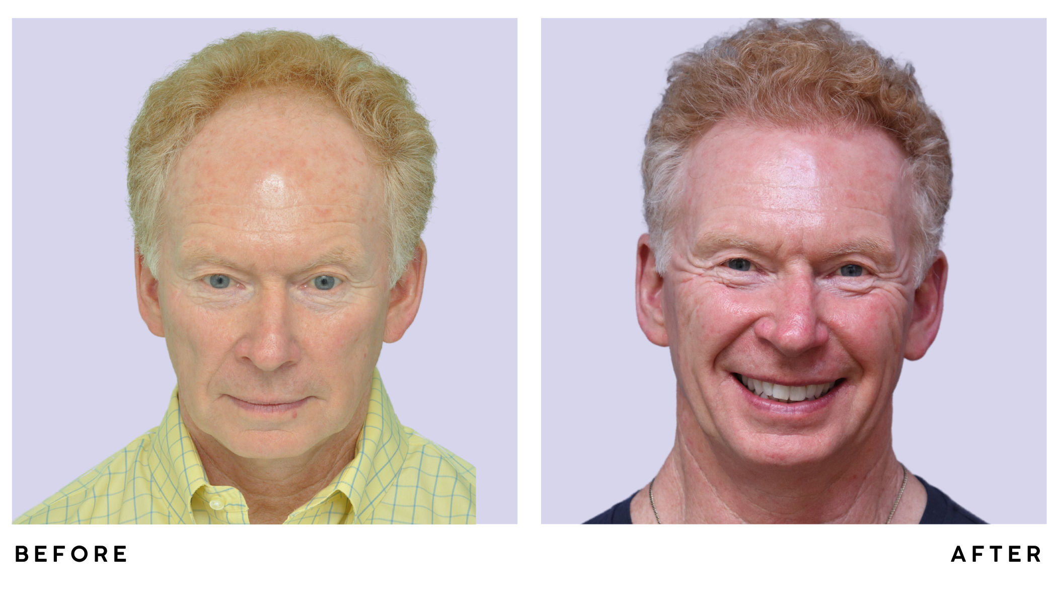 A patient's hair before and after