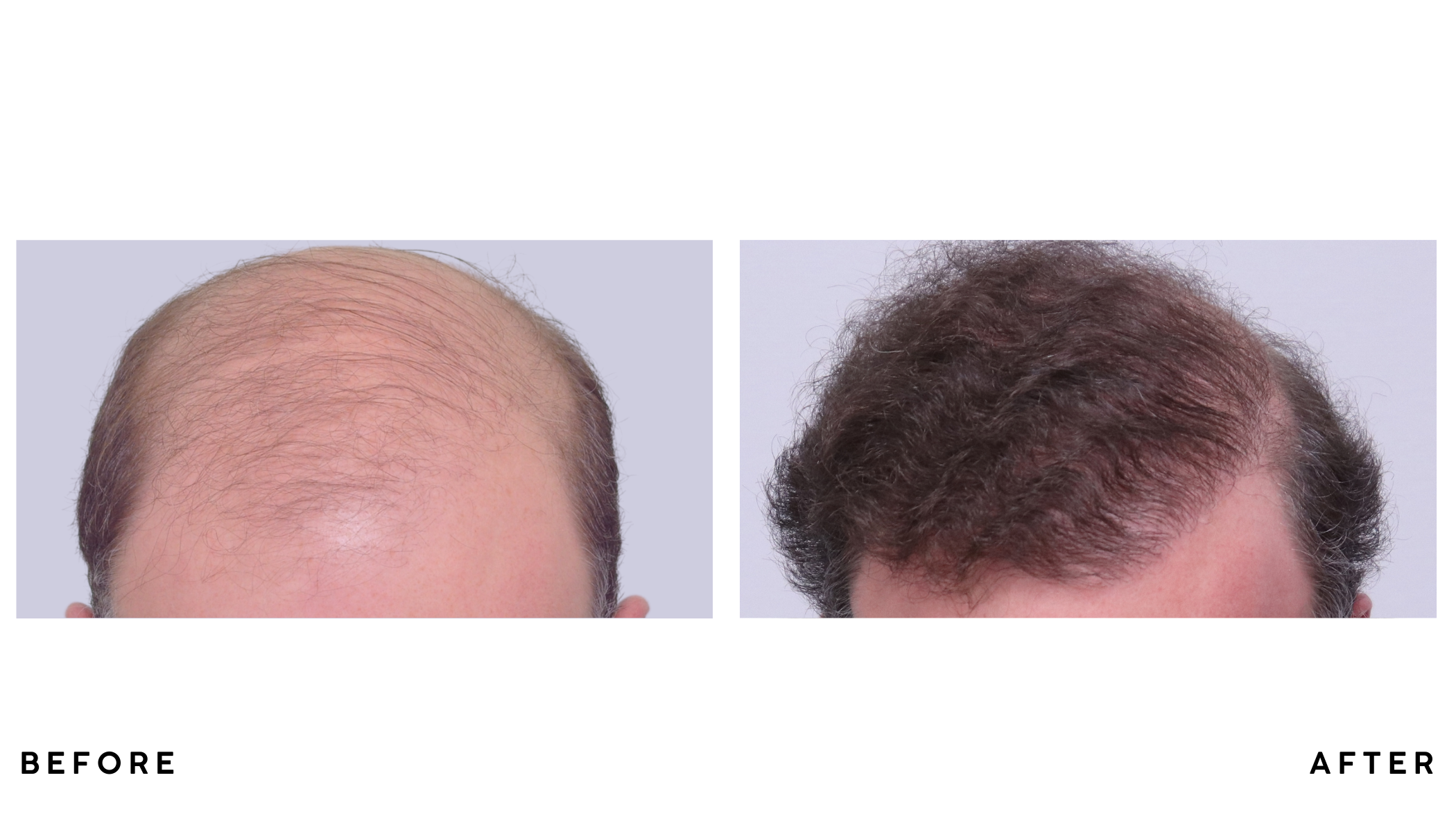 A patient's hair before and after