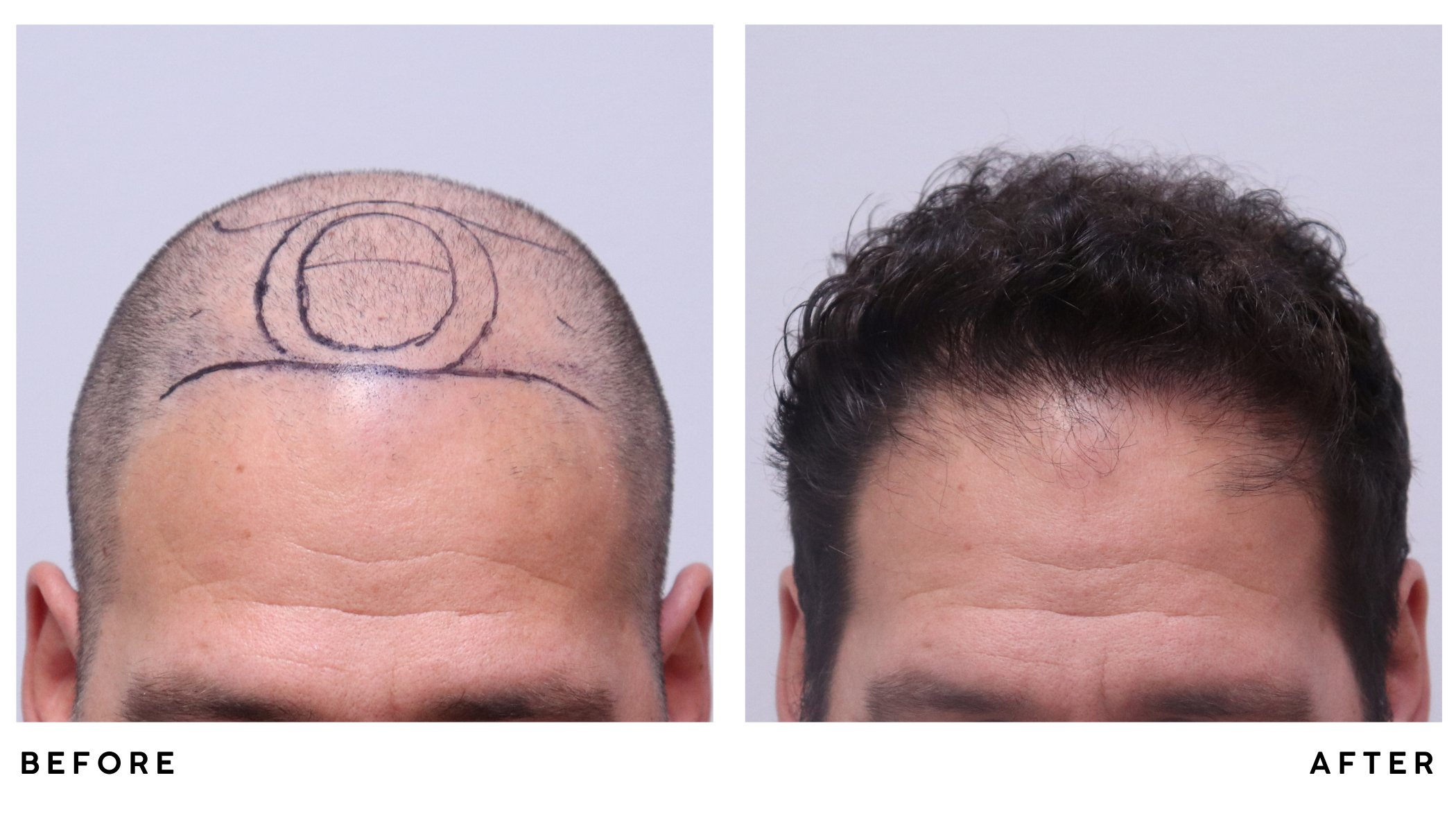 A patient's hair before and after