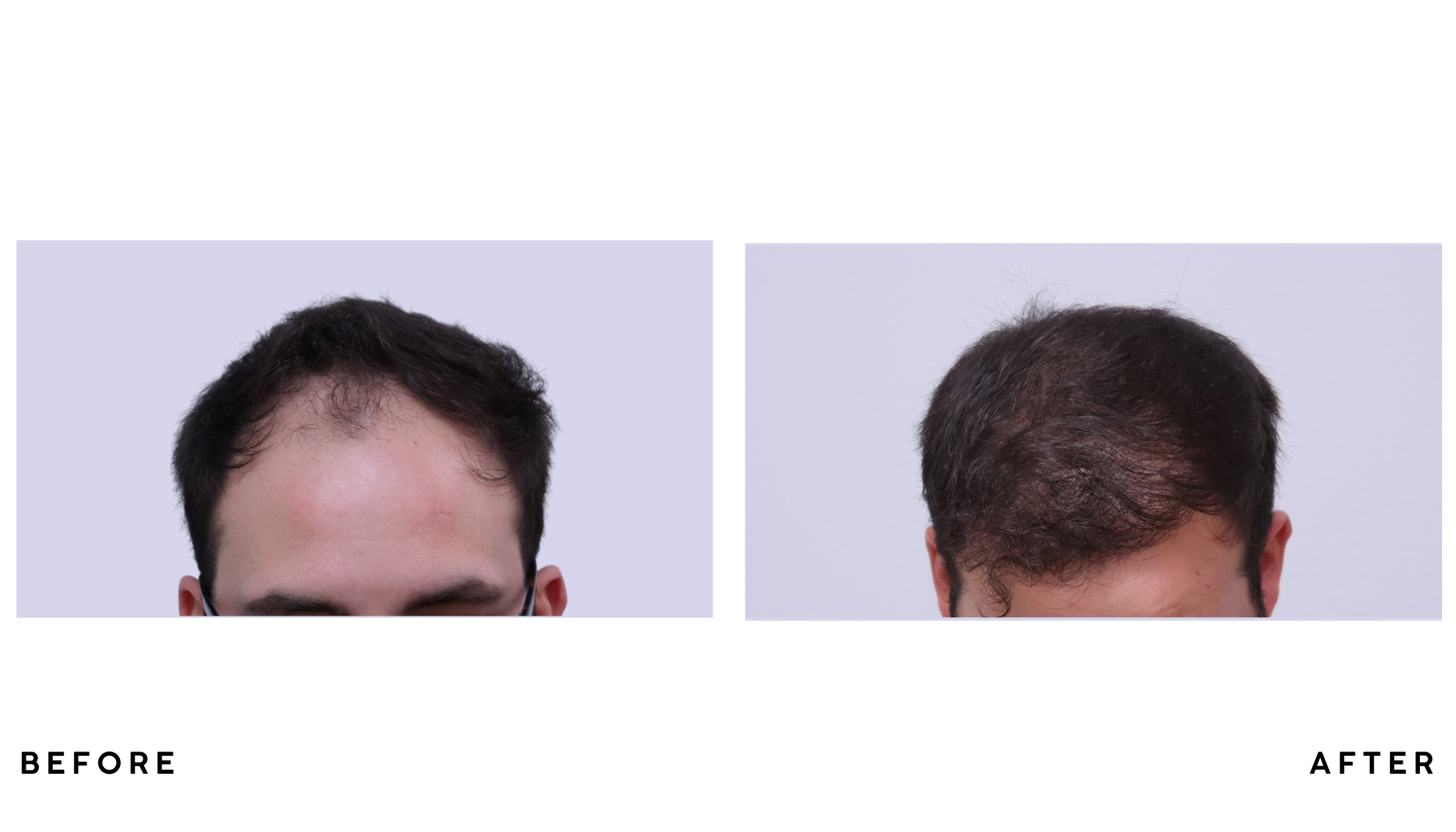 A patient's hair before and after