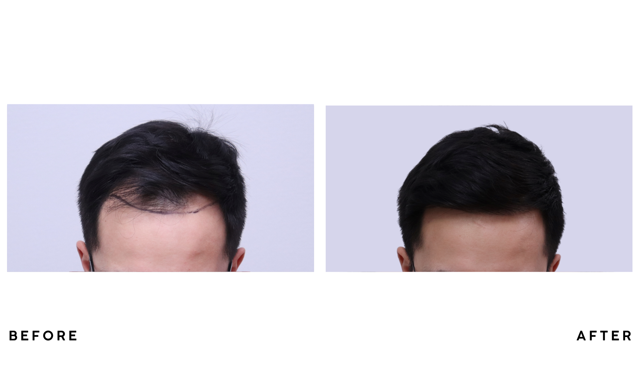 A patient's hair before and after